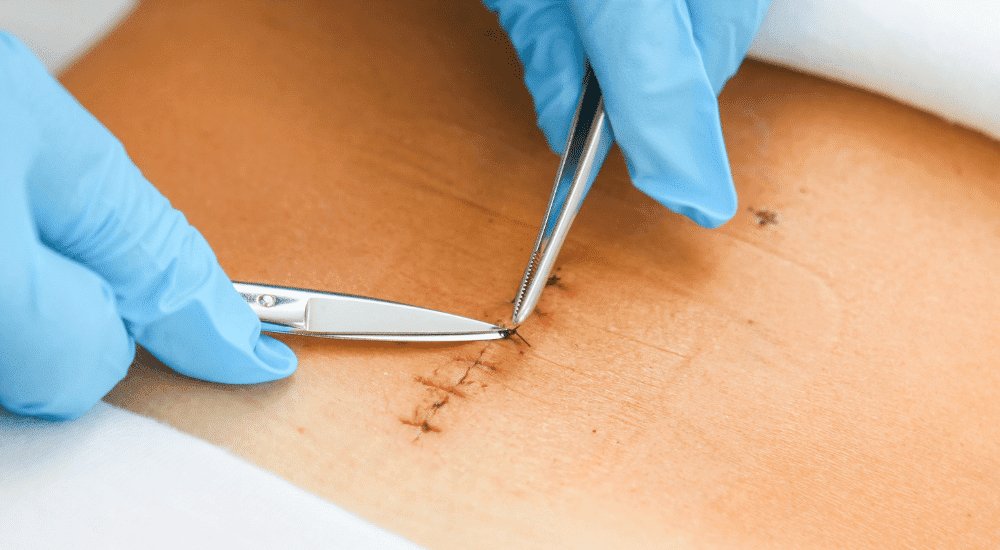 Removal of staples or stitches after surgery